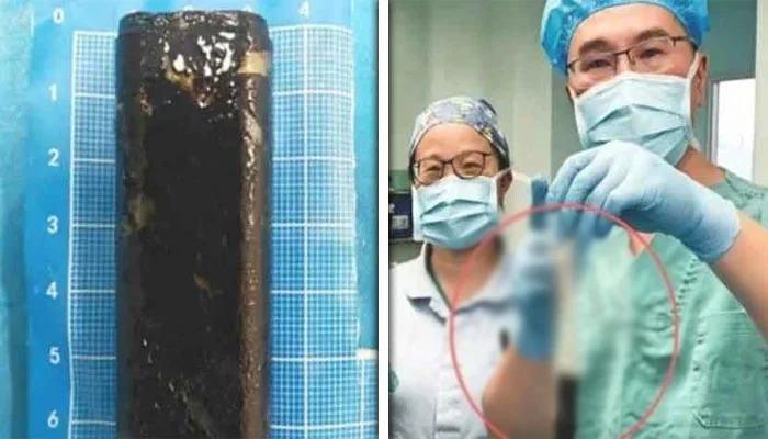 30 سال بعد مریض کے معدے سے لائٹر برآمد، ڈاکٹر بھی دنگ رہ گئے